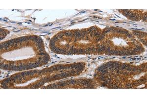 Immunohistochemistry of paraffin-embedded Human colon cancer tissue using PDCD7 Polyclonal Antibody at dilution 1:60 (PDCD7 anticorps)