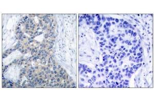Immunohistochemical analysis of paraffin-embedded human breast carcinoma tissue using Stathmin 1 (phospho-Ser37) antibody (E011225). (Stathmin 1 anticorps  (pSer37))