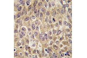 IHC analysis of FFPE human hepatocarcinoma tissue stained with AFP antibody (alpha Fetoprotein anticorps  (AA 56-85))