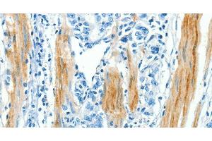 Immunohistochemistry of paraffin-embedded Human gastic cancer using CAV3 Polyclonal Antibody at dilution of 1:30 (Caveolin 3 anticorps)