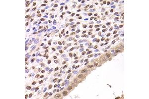 Immunohistochemistry of paraffin-embedded human adenomyosis using FKBP4 Antibody (ABIN5973289) at dilution of 1/200 (40x lens). (FKBP4 anticorps)