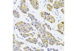 Immunohistochemistry of paraffin-embedded human breast cancer using RFC4 Antibody (ABIN5973195) at dilution of 1/100 (40x lens). (RFC4 anticorps)
