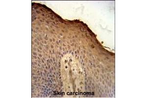 ISM1 Antibody (C-term) (ABIN651237 and ABIN2840147) immunohistochemistry analysis in formalin fixed and paraffin embedded human skin carcinoma followed by peroxidase conjugation of the secondary antibody and DAB staining. (ISM1 anticorps  (AA 435-464))