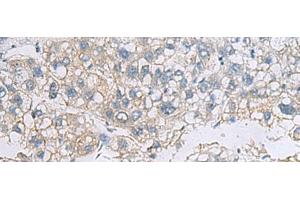 Immunohistochemistry of paraffin-embedded Human liver cancer tissue using VEGFA Polyclonal Antibody at dilution of 1:45(x200) (VEGFA anticorps)