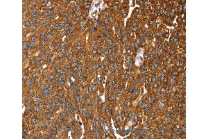 Immunohistochemistry of Human liver cancer using RASSF3 Polyclonal Antibody at dilution of 1:35 (RASSF3 anticorps)