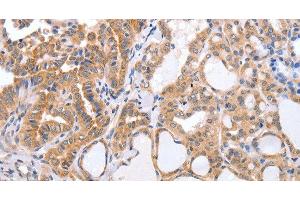 Immunohistochemistry of paraffin-embedded Human thyroid cancer tissue using TGFA Polyclonal Antibody at dilution 1:60 (TGFA anticorps)