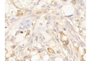 Detection of CK10 in Human Ovarian cancer Tissue using Polyclonal Antibody to Cytokeratin 10 (CK10)