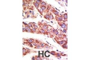 Formalin-fixed and paraffin-embedded human cancer tissue reacted with the primary antibody, which was peroxidase-conjugated to the secondary antibody, followed by AEC staining.
