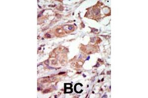 Formalin-fixed and paraffin-embedded human cancer tissue reacted with the MAP3K10 polyclonal antibody  , which was peroxidase-conjugated to the secondary antibody, followed by DAB staining.