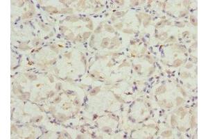 Immunohistochemistry of paraffin-embedded human gastric cancer using ABIN7175358 at dilution of 1:100