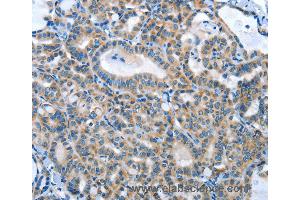Immunohistochemistry of Human thyroid cancer using ANGPT2 Polyclonal Antibody at dilution of 1:45 (Angiopoietin 2 anticorps)