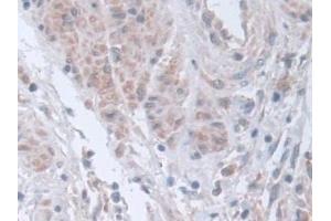 Detection of STIP1 in Human Prostate cancer Tissue using Polyclonal Antibody to Stress Induced Phosphoprotein 1 (STIP1)