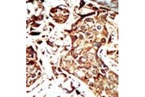 Formalin-fixed and paraffin-embedded human cancer tissue reacted with the primary antibody, which was peroxidase-conjugated to the secondary antibody, followed by AEC staining.