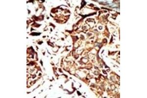 Formalin-fixed and paraffin-embedded human cancer tissue reacted with the primary antibody, which was peroxidase-conjugated to the secondary antibody, followed by AEC staining. (BRD3 anticorps  (C-Term))