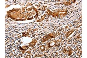 The image on the left is immunohistochemistry of paraffin-embedded Human gastric cancer tissue using ABIN7130598(PGC Antibody) at dilution 1/25, on the right is treated with fusion protein. (PGC anticorps)