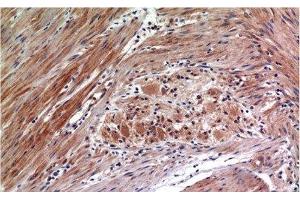 Immunohistochemistry of paraffin-embedded Human colon carcinoma tissue with Phospho-ERK 1/2 (Tyr222/205) Monoclonal Antibody at dilution of 1:200 (ERK1/2 anticorps  (pTyr205, pTyr222))