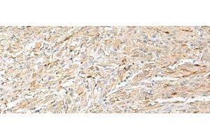 Immunohistochemistry of paraffin-embedded Human liver cancer tissue using EPRS Polyclonal Antibody at dilution of 1:60(x200)