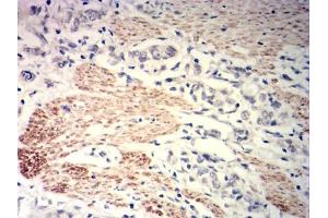 Immunohistochemical analysis of paraffin-embedded gastric cancer tissues using MYLK mouse mAb with DAB staining. (MYLK anticorps  (AA 1375-1524))