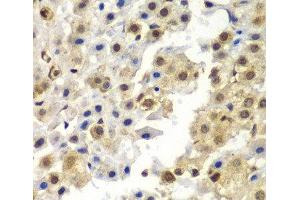 Immunohistochemistry of paraffin-embedded Human liver cancer using SYNCRIP Polyclonal Antibody at dilution of 1:100 (40x lens). (SYNCRIP anticorps)
