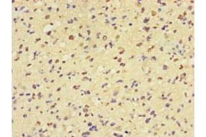 Immunohistochemistry of paraffin-embedded human glioma using ABIN7160057 at dilution of 1:100 (MAP3K8 anticorps  (AA 1-300))