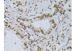 Immunohistochemistry of paraffin-embedded human gastric cancer using EMD antibody. (Emerin anticorps  (AA 1-220))
