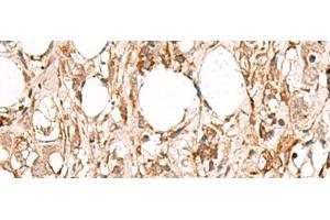 Immunohistochemistry of paraffin-embedded Human breast cancer tissue using FBXW8 Polyclonal Antibody at dilution of 1:65(x200) (FBXW8 anticorps)