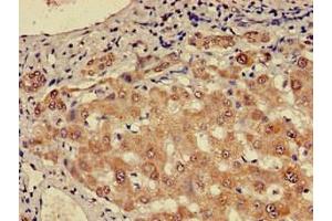 Immunohistochemistry of paraffin-embedded human liver cancer using ABIN7147724 at dilution of 1:100 (CHD5 anticorps  (AA 1600-1699))