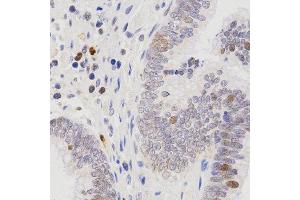 Immunohistochemistry of paraffin-embedded human rectal cancer tissue using SCTR antibody at dilution of 1:200 (x400 lens) (SCTR anticorps)