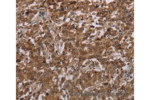 Immunohistochemistry of Human liver cancer using TBX5 Polyclonal Antibody at dilution of 1:35 (T-Box 5 anticorps)