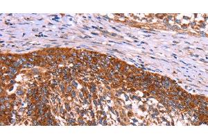 Immunohistochemistry of paraffin-embedded Human cervical cancer using ABI1 Polyclonal Antibody at dilution of 1:40 (ABI1 anticorps)