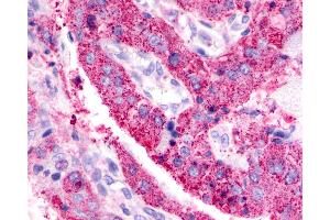 Anti-BAI3 antibody IHC of human Lung, Adenocarcinoma.