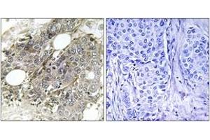 Immunohistochemistry analysis of paraffin-embedded human breast carcinoma tissue, using TGF beta Receptor III (Ab-842) Antibody.