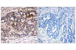 Immunohistochemical analysis of paraffin-embedded human breast carcinoma tissue, using Shc1 (Ab-427) antibody (E021317). (SHC1 anticorps)