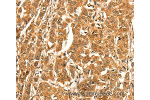 Immunohistochemistry of Human esophagus cancer using DIRAS1 Polyclonal Antibody at dilution of 1:52 (DIRAS1 anticorps)