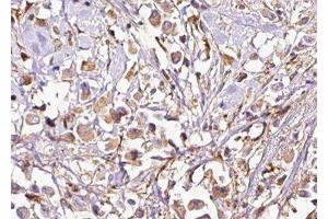 ABIN6277546 at 1/100 staining Human breast cancer tissue by IHC-P. (VAPB anticorps  (C-Term))