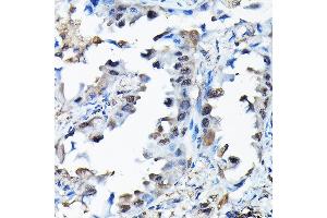 Immunohistochemistry of paraffin-embedded human lung cancer using RBBP9 Rabbit pAb (ABIN6129095, ABIN6146752, ABIN6146753 and ABIN6220638) at dilution of 1:200 (40x lens). (RBBP9 anticorps  (AA 1-186))