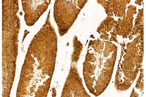 ABIN6259902 and ABIN6272954 at 1/100 staining Human gastric cancer by IHC-P.