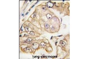 Formalin-fixed and paraffin-embedded human lung carcinoma tissue reacted with VGFR3 Monoclonal Antibody (ABIN387818 and ABIN2843906) , which was peroxidase-conjugated to the secondary antibody, followed by DAB staining.