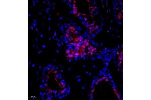 Immunofluorescence of paraffin embedded human breast cancer using Suv39h2 (ABIN7075771) at dilution of 1:2000 (400x lens) (SUV39H2 anticorps)