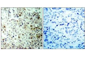 Immunohistochemical analysis of paraffin- embedded human breast carcinoma tissue, using CDK2 (phospho-Thr160) antibody (E011133). (CDK2 anticorps  (pThr160))