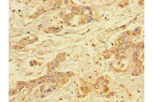 Immunohistochemistry of paraffin-embedded human pancreatic cancer using ABIN7143770 at dilution of 1:100 (ALG2 anticorps  (AA 303-405))