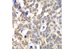 Immunohistochemistry of paraffin-embedded human esophageal cancer using PARN antibody (ABIN5972174) at dilution of 1/100 (40x lens). (PARN anticorps)