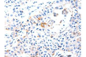 The image on the left is immunohistochemistry of paraffin-embedded Human lung cancer tissue using ABIN7191546(MUC3A Antibody) at dilution 1/60, on the right is treated with synthetic peptide.