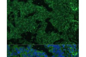 Immunofluorescence analysis of Human lung cancer cells using IL25 Polyclonal Antibody at dilution of 1:100.