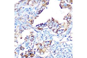Immunohistochemistry of paraffin-embedded human oophoroma using YB-1/YBX1 Rabbit mAb (ABIN7271410) at dilution of 1:100 (40x lens).