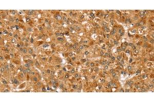 Immunohistochemistry of paraffin-embedded Human liver cancer using STX3 Polyclonal Antibody at dilution of 1:35