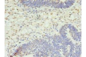 Immunohistochemistry of paraffin-embedded human ovarian cancer using ABIN7169003 at dilution of 1:100