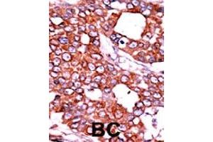 Formalin-fixed and paraffin-embedded human cancer tissue reacted with CDC25A (phospho T506) polyclonal antibody  which was peroxidase-conjugated to the secondary antibody followed by AEC staining. (CDC25A anticorps  (pThr507))