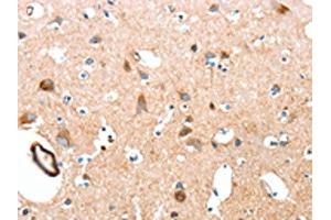 The image on the left is immunohistochemistry of paraffin-embedded Human brain tissue using ABIN7189570(AARS Antibody) at dilution 1/50, on the right is treated with synthetic peptide. (AARS anticorps)