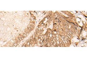 Immunohistochemistry of paraffin-embedded Human colorectal cancer tissue using HIPK3 Polyclonal Antibody at dilution of 1:60(x200) (HIPK3 anticorps)
